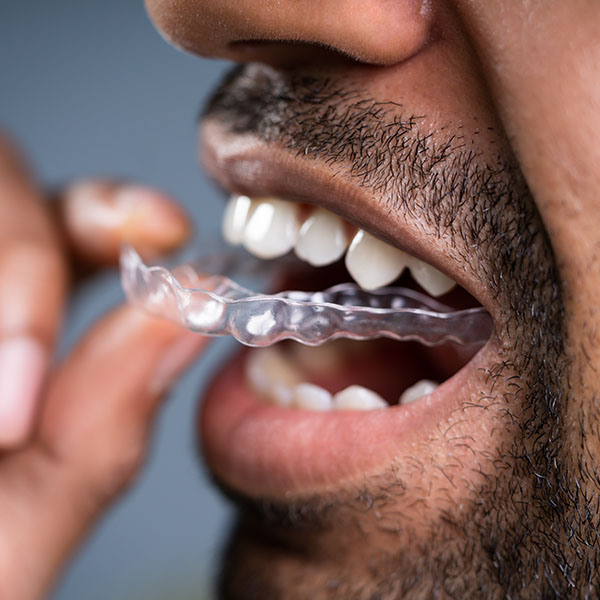 Orthodontie adulte – Traitement avec gouttières – aligneurs